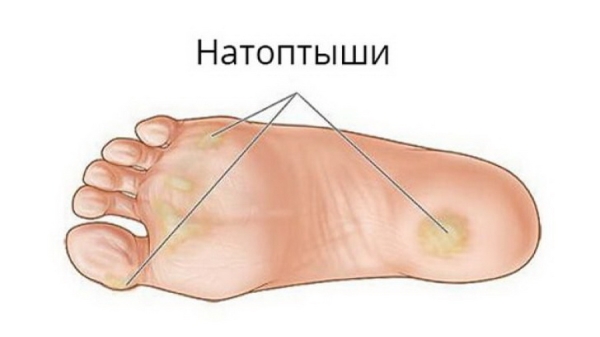 Ходьба в удовольствие: как убрать натоптыши на ногах Ходьба в удовольствие: как убрать натоптыши на ногах
